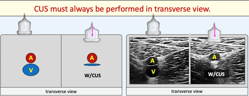 CUS must always be performed in transverse view