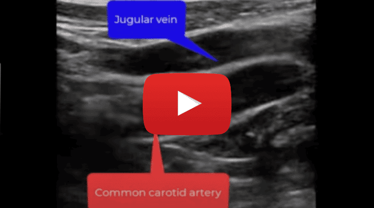 Common carotid artery partiallyv