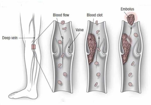 Dvt Cancer Rle DVT Deep Vein Thrombosis Awareness Month 2023 - ABC Vascular
