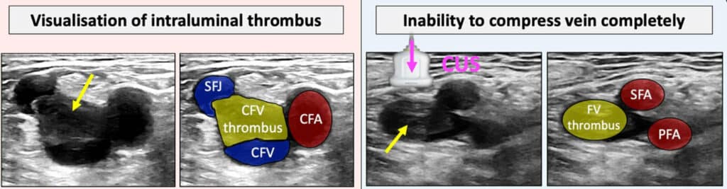 Deep Vein Thrombosis Dvt Ultrasound Scanning Technique – NBKomputer