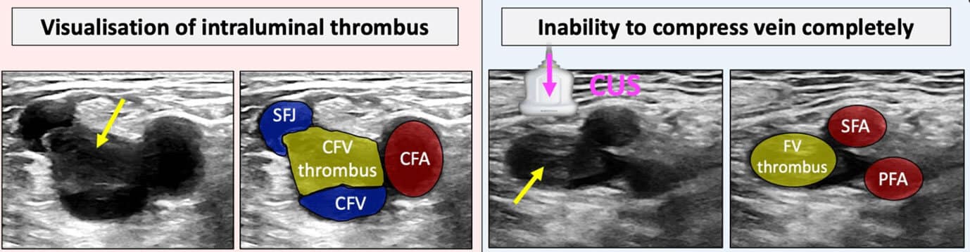 Acute Dvt Ultrasound