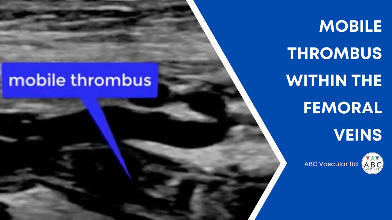 Free Floating Distal Thrombus Tongue