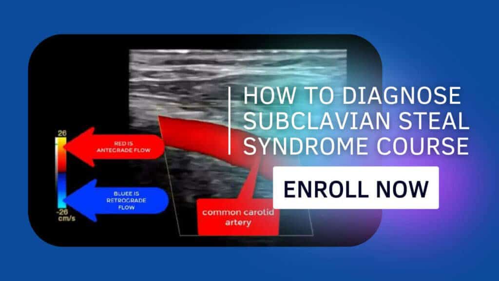 How to Diagnose Subclavian Steal Syndrome Course + CME Quiz