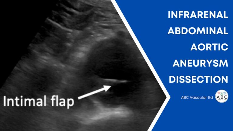 Infrarenal Abdominal Aortic Aneurysm With Chronic Dissection