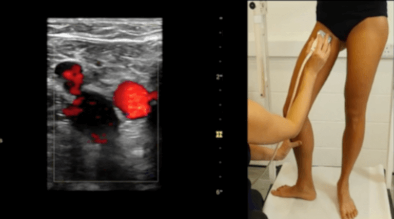 Lower limb venous ultrasound