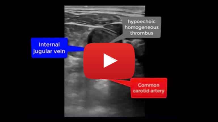 acute-deep-vein-thrombosis-of-0.75