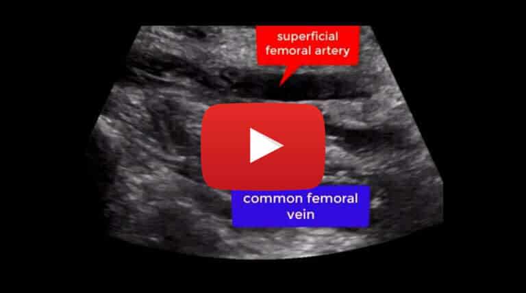 deep-vein-thrombosis-in-intravenous-0.75