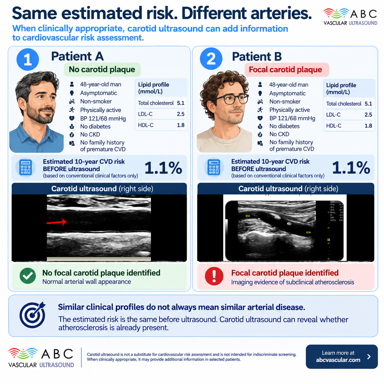 Carotid Ultrasound and Cardiovascular Risk Assessment