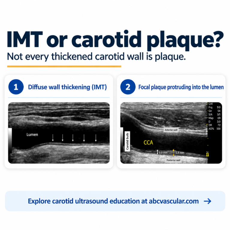 IMT vs Plaque on Carotid Ultrasound: How to Tell Them Apart