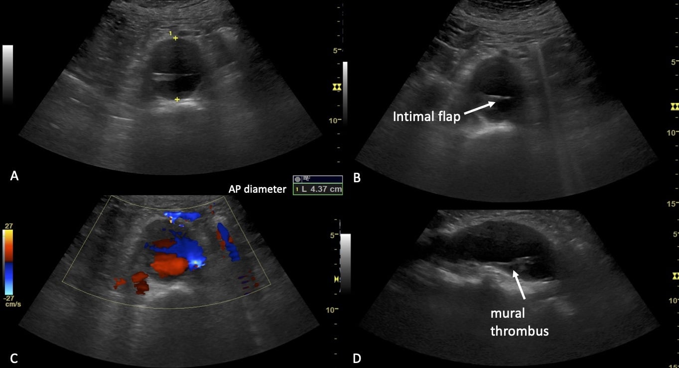 abdominal aortic aneurysm ultrasound