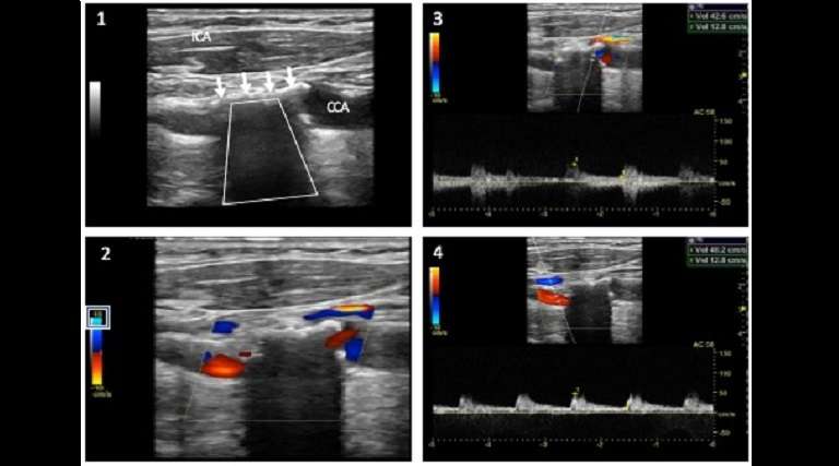 internal carotid artery calcified plaque 0.75