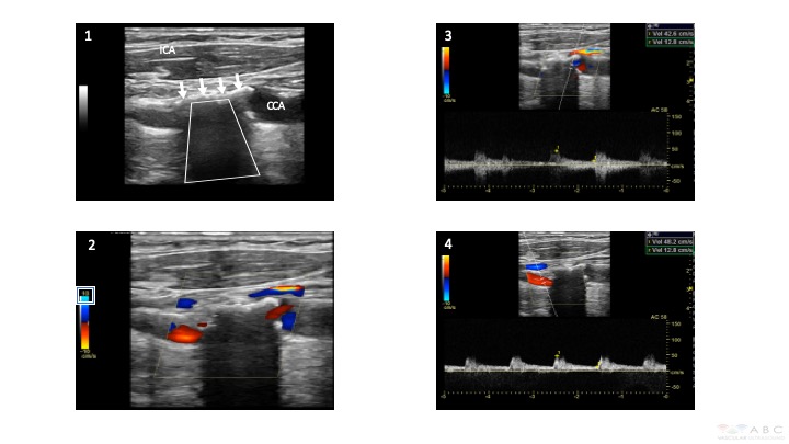 Internal Carotid Artery Calcified Plaque With Acoustic Shadow