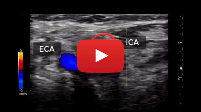 intracranial-occlusion-of-the-interna