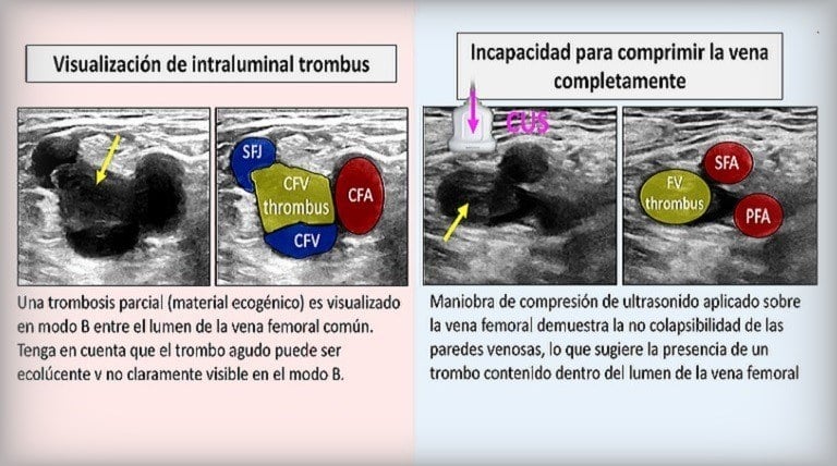 Como Diagnosticar Trombosis Venosa Profunda Poplítea Femoral + CME Quiz