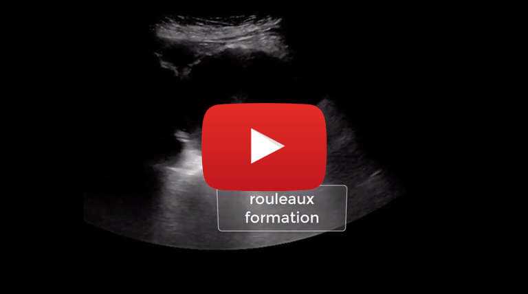 rouleaux-formation-in-an-abdomina