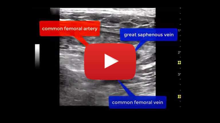 thrombophlebitis-of-the-great-saphenous-0.75