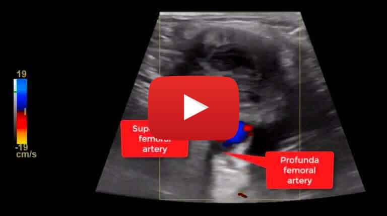 thrombosed-common-femoral-artery-pseudoaneurysm