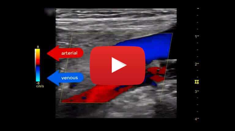 popliteal vein ultrasound