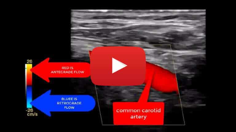 vertebral-artery-complete-steal-syndrome